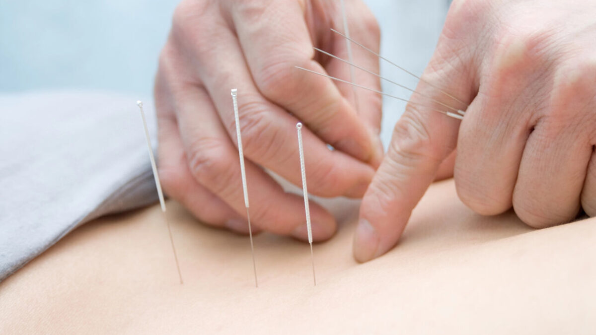 acupuncture for back pain burnaby