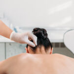 acupuncture for neck pain burnaby