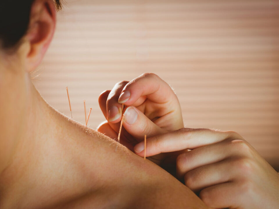 acupuncture benefits burnaby