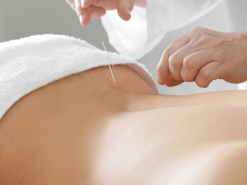 acupuncture for sciatica burnaby