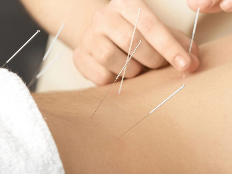 acupuncture for back pain burnaby