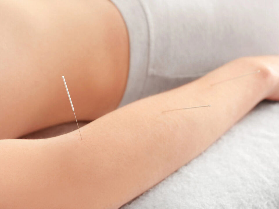 acupuncture for arthritis burnaby