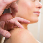 acupuncture for shoulder pain burnaby