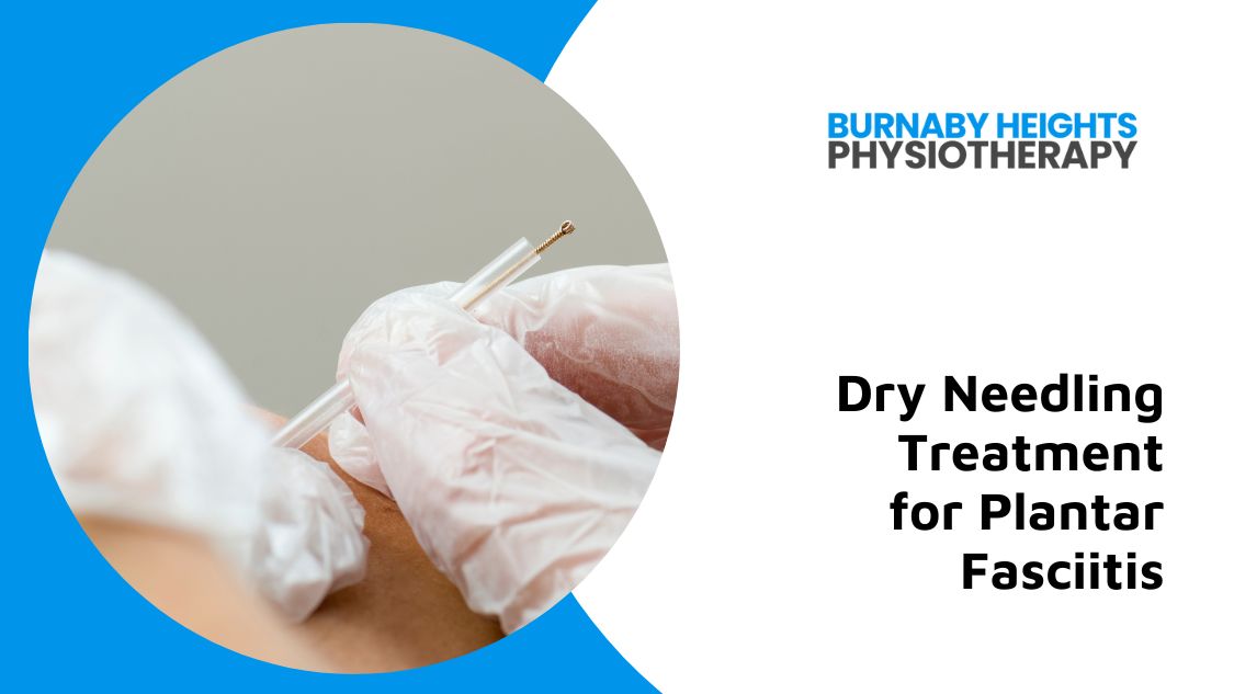 Dry needling for plantar fasciitis burnaby bc