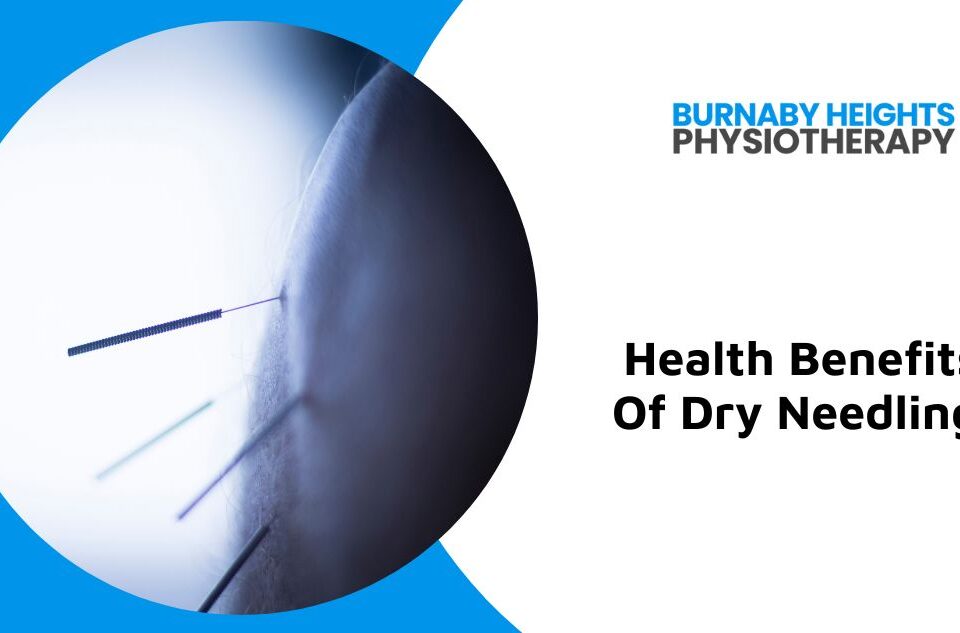 dry needling physiotherapy burnaby