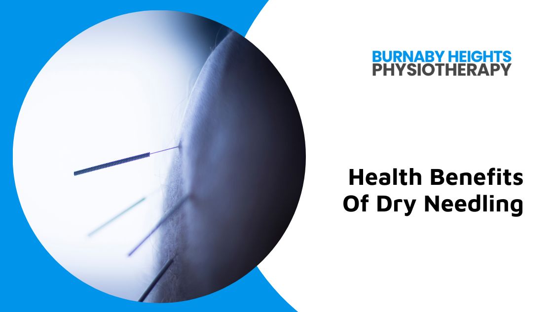 dry needling physiotherapy burnaby