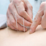 acupuncture for back pain burnaby