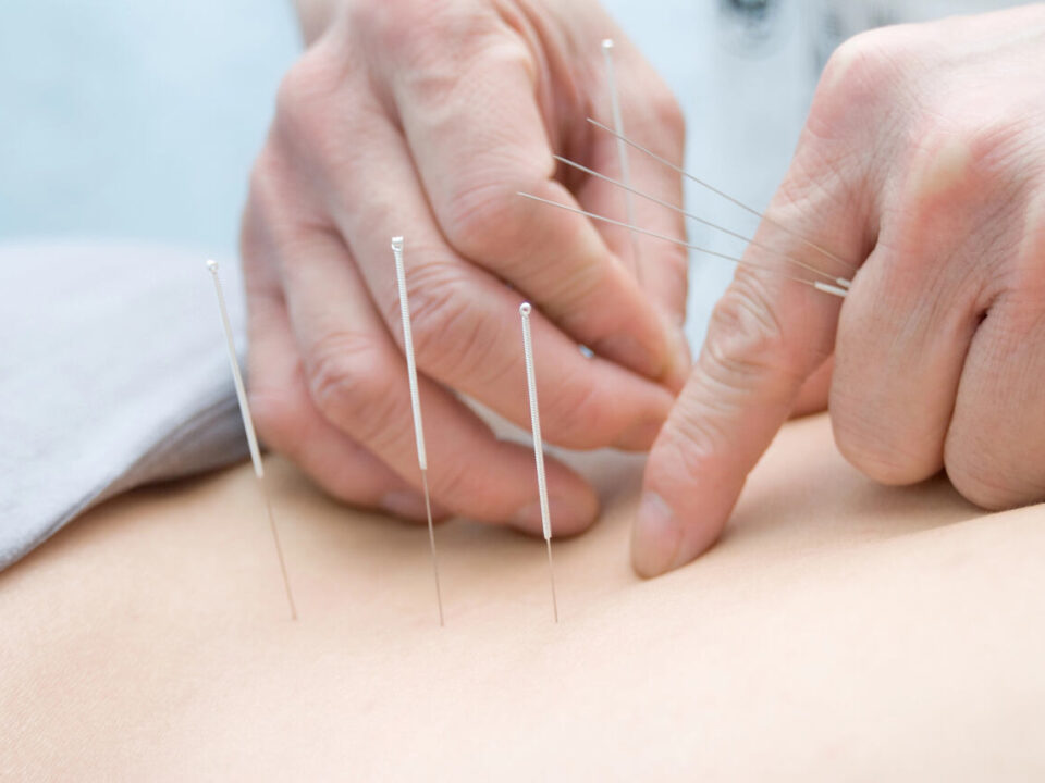 acupuncture for back pain burnaby