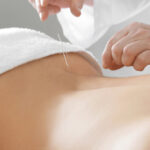 acupuncture for sciatica burnaby