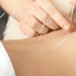 acupuncture for back pain burnaby