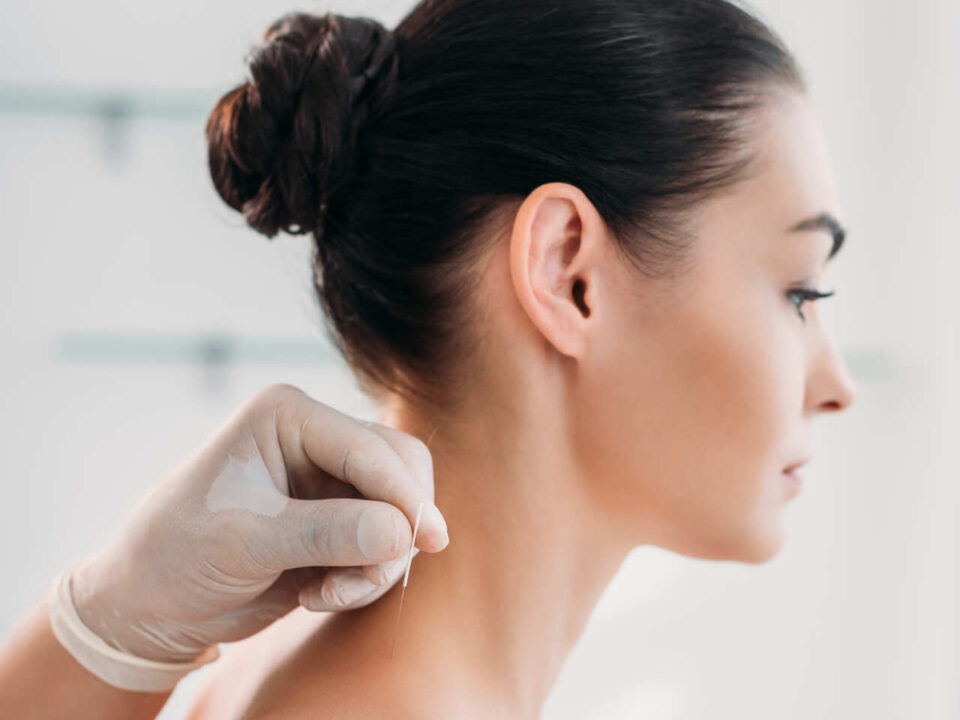 acupuncture for neck pain burnaby