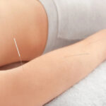 acupuncture for arthritis burnaby