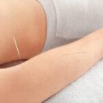 acupuncture for tennis elbow burnaby