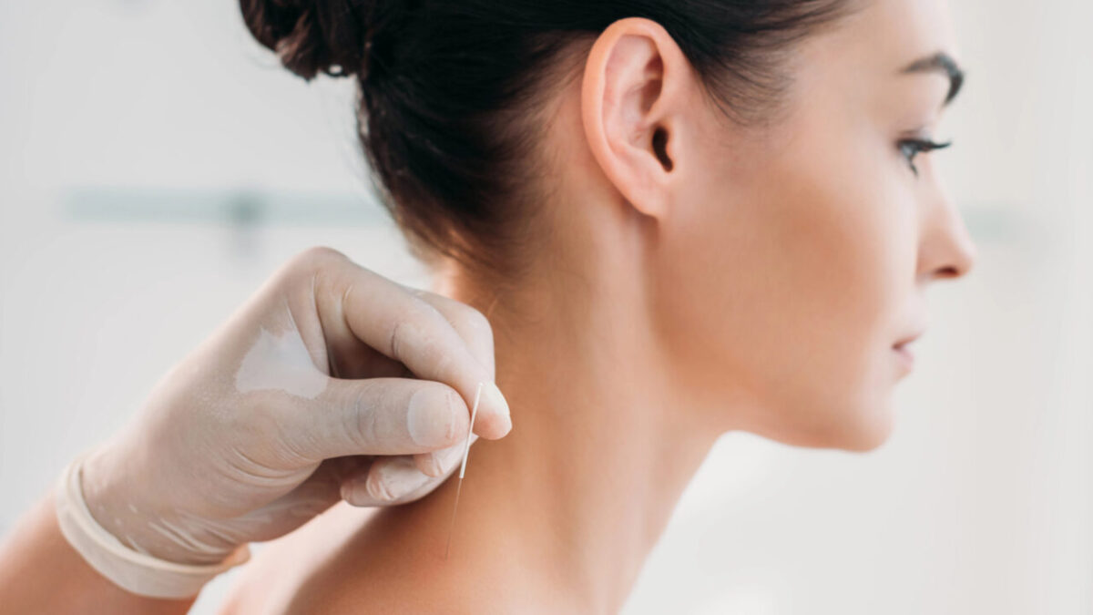 benefits of acupuncture burnaby
