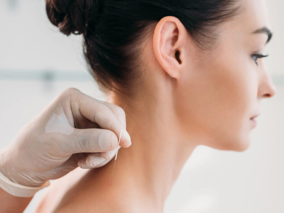 benefits of acupuncture burnaby