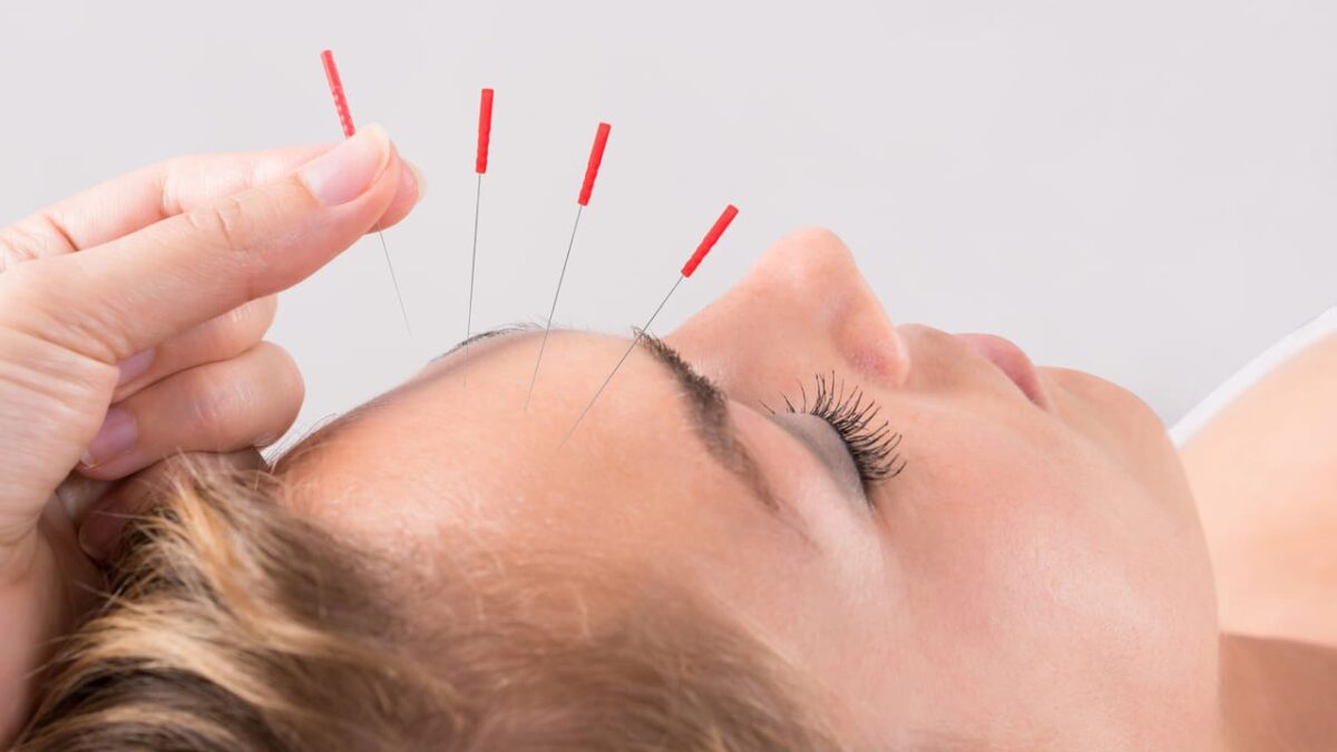 myths about acupuncture burnaby