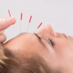myths about acupuncture burnaby
