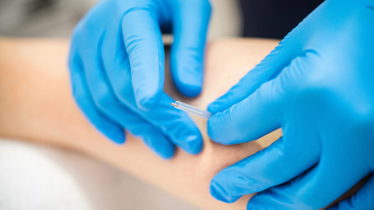 acupuncture vs dry needling burnaby