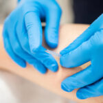 acupuncture vs dry needling burnaby