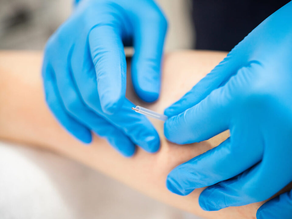 acupuncture vs dry needling burnaby