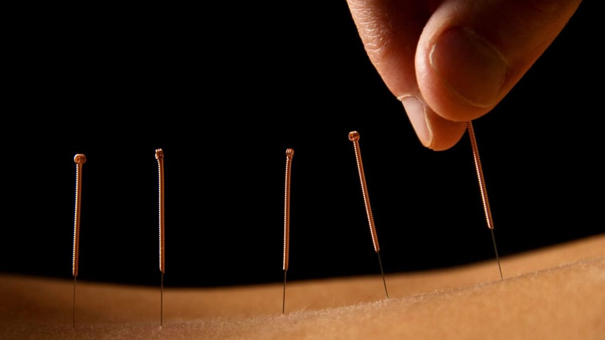 acupuncture vs dry needling