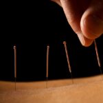 acupuncture vs dry needling