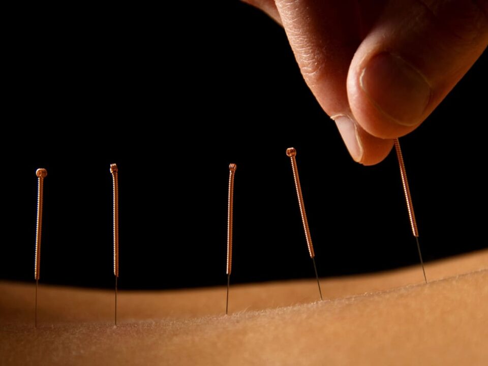 acupuncture vs dry needling
